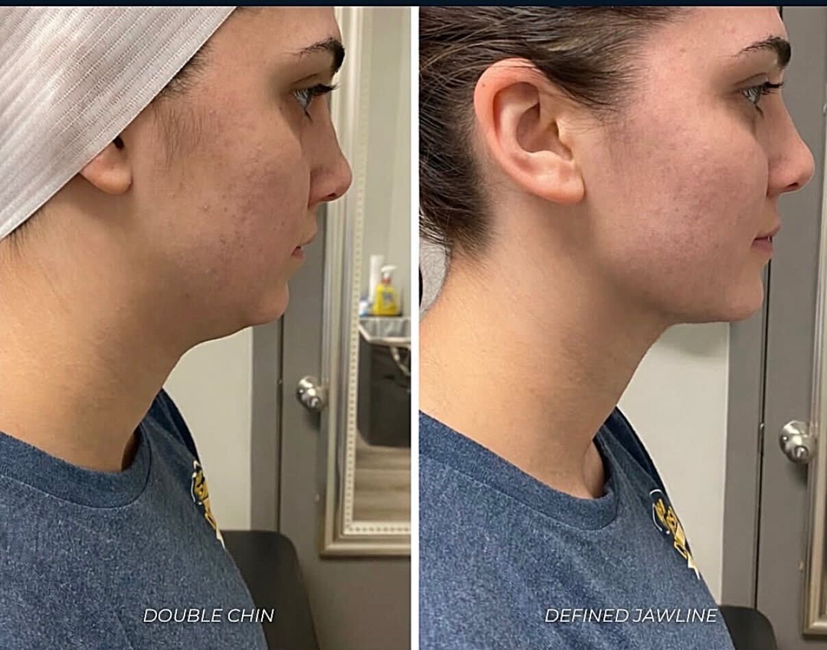 Double Chin Slim & Tone results SkinnyGlow