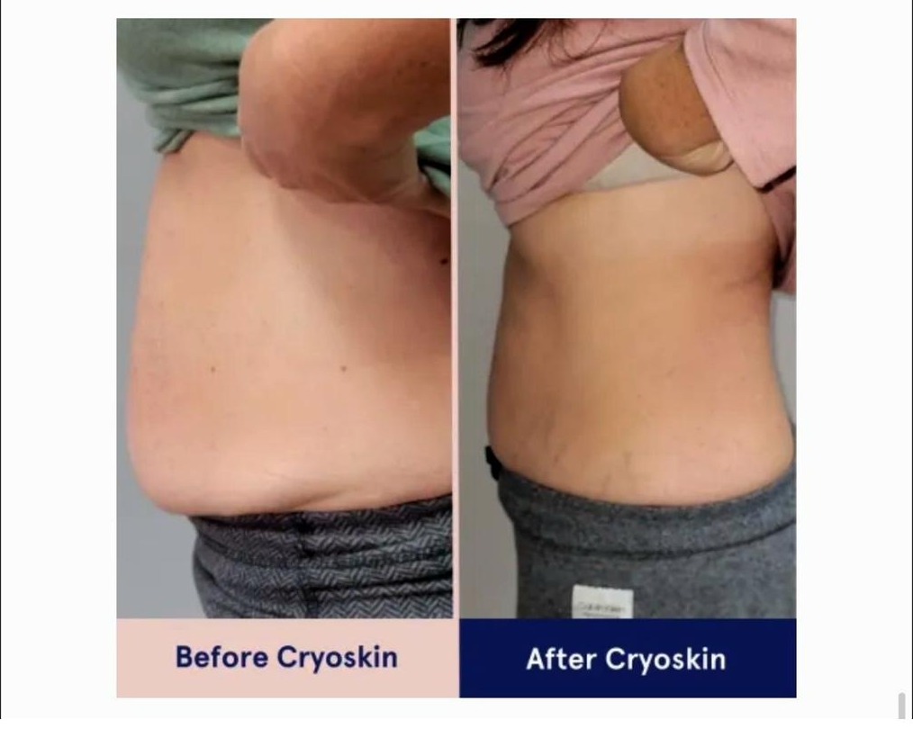 CryoSlimming results SkinnyGlow