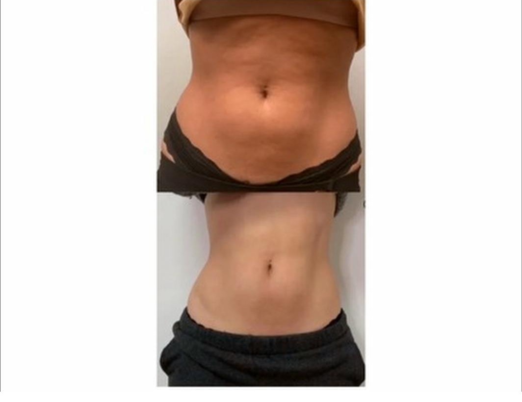CryoSlimming results SkinnyGlow