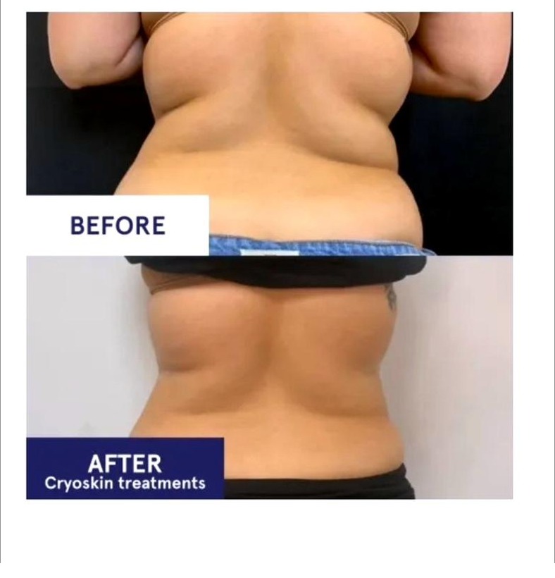 CryoSlimming results SkinnyGlow