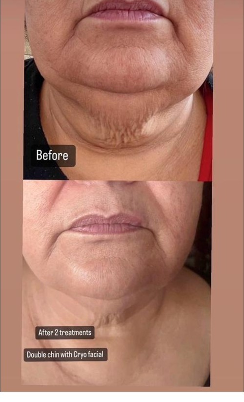 Cryo Facial double chin results SkinnyGlow