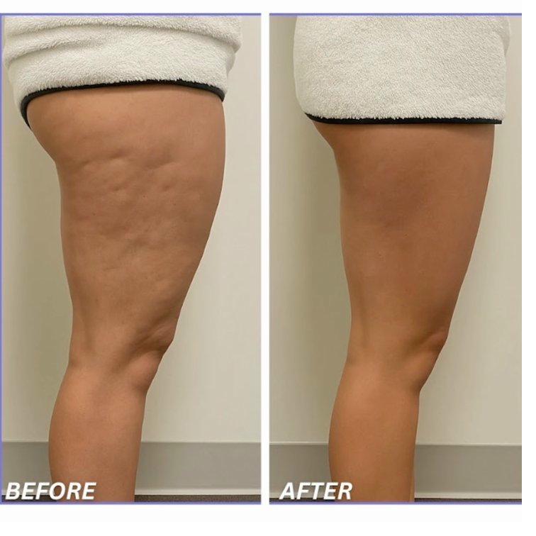 Body toning results SkinnyGlow La Quinta